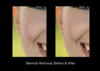 Blemish Removal